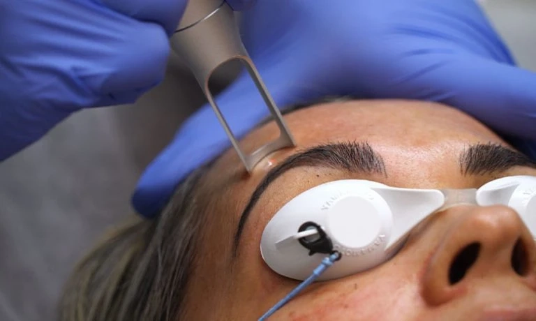 Is It Possible to Remove Old Tattoos Completely With Laser in Dubai?