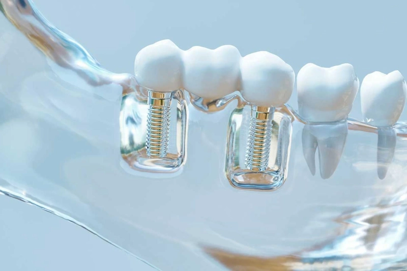 What is Single Implant Dental?