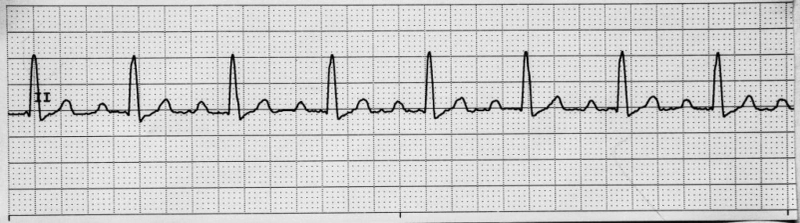 Smartwatches vs ECG – What They Miss