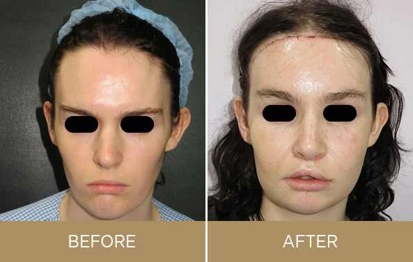 Facial Feminization Surgery USA