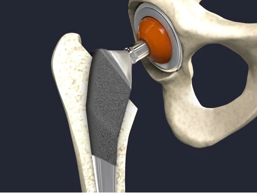 Orthopedic Innovations: A Look at the Artificial Joints Market