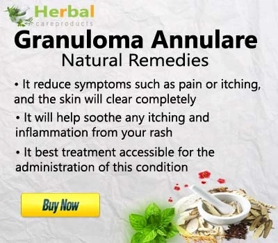 Herbal Treatment for Granuloma Annulare | Remedies | Herbal Care Products