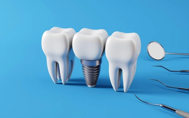 How to Care for Your Dental Implants for Long-Term Success