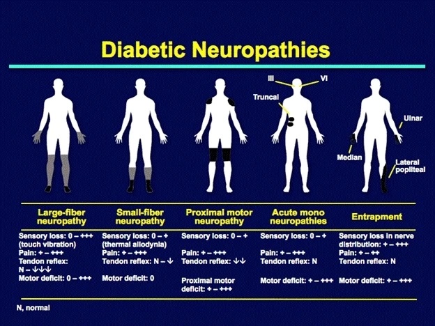 What is the cause of diabetic neuropathy?