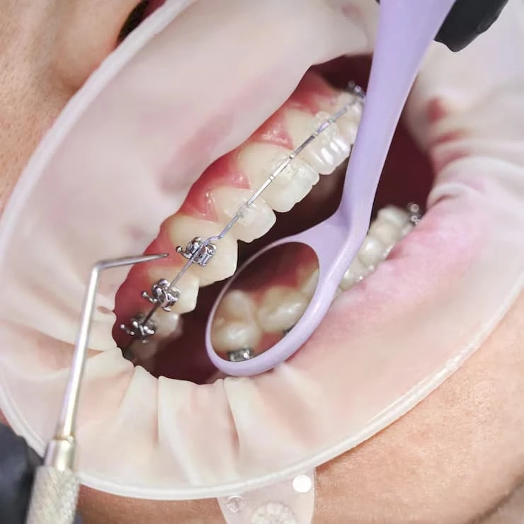 How Ceramic Braces Offer a More Natural Appearance
