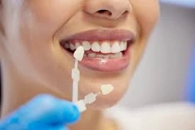 The Complete Guide to Dental Veneer Treatment