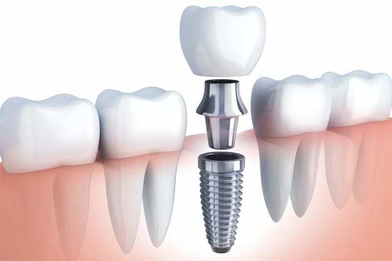 Affordable Dental Implants San Diego @ Mesadentalsd