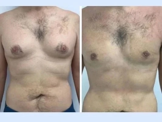 Best Doctors in Dubai for Gynecomastia with financing support