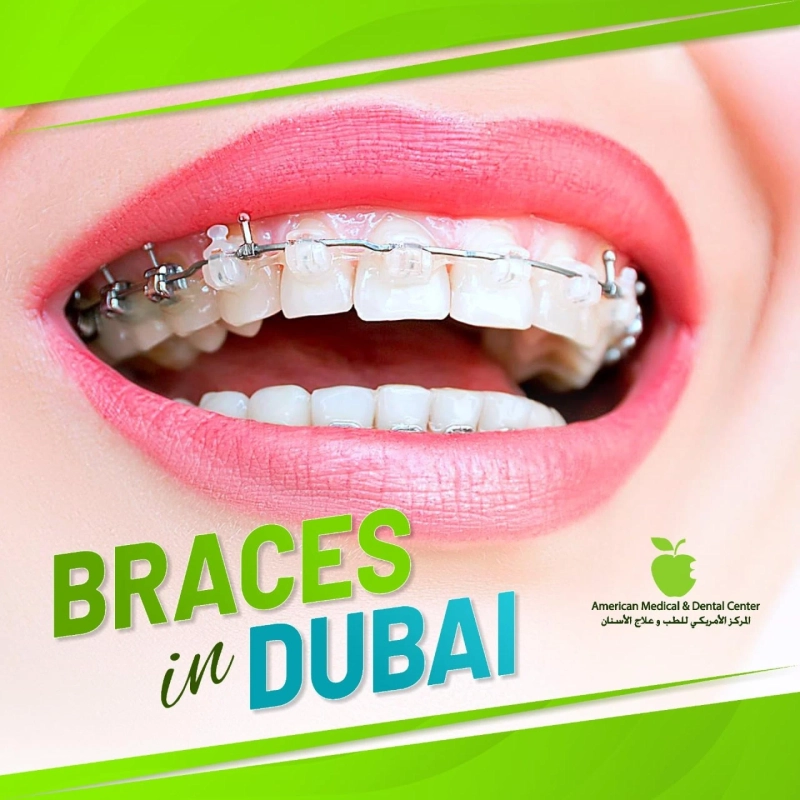 WHERE IS THE BEST PLACE TO GET BRACES IN DUBAI