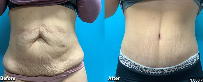 Tummy Tuck Scars and Self-Confidence: What to Expect Emotionally