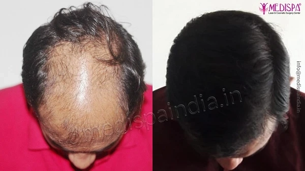 Explain The Importance Of Donor Area In Hair Restoration