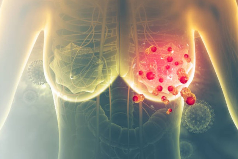 Comprehensive Breast Cancer Treatment in Meerut: Valentis Cancer Hospital Leads the Way