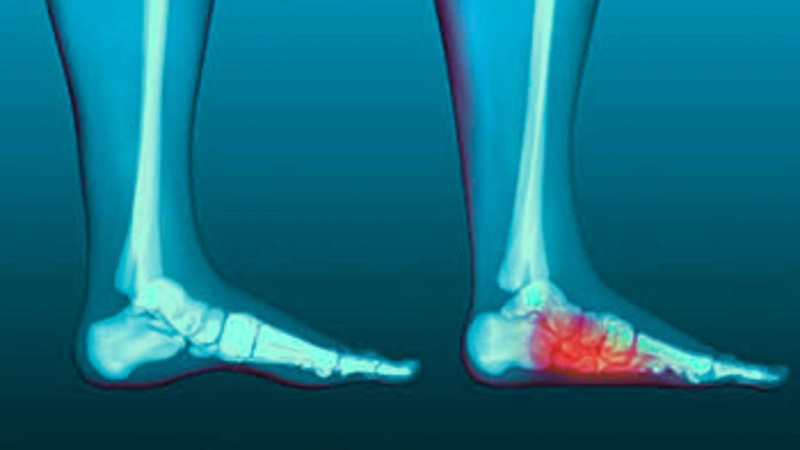 How to Fix Flat Feet: Treatment Options and When to See a Specialist