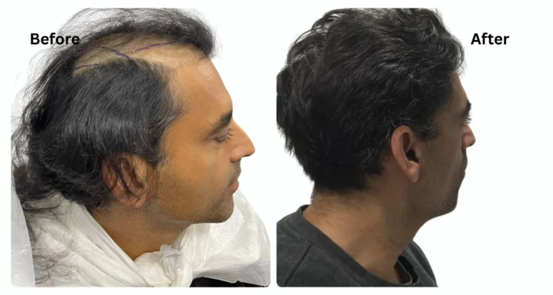 What Influences Sapphire FUE Hair Transplant Turkey Cost?