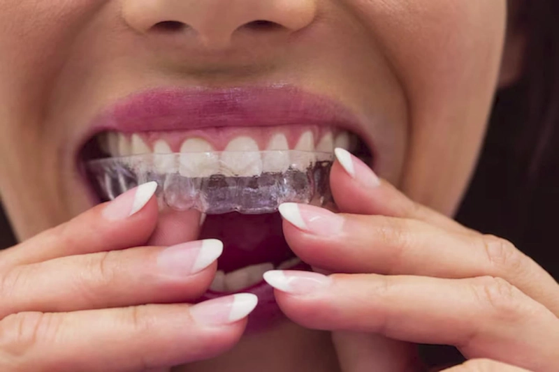 Invisalign Dentist vs. Traditional Orthodontist: What’s the Difference?