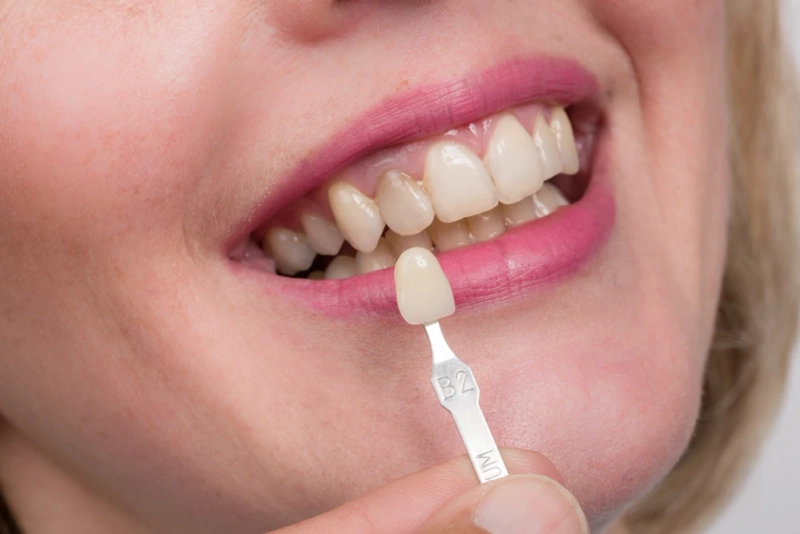 Same Day Crowns Improve the Appearance of Your Teeth