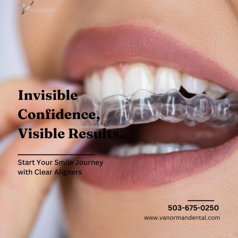 Smilers Clear Aligners: The Clear Solution for Beautifully Aligned Teeth