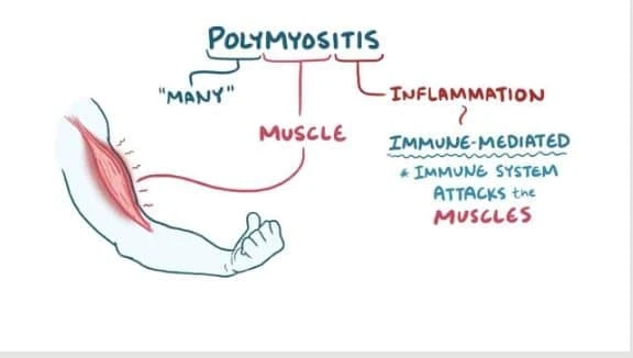 Polymyositis - Symptoms, Causes, and Treatment