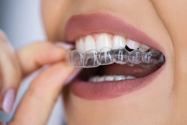 Discover a Confident Smile: Why Traverse City Invisalign Is Transforming Orthodontic Care