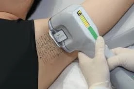 What Is Sweat Gland Removal Surgery?