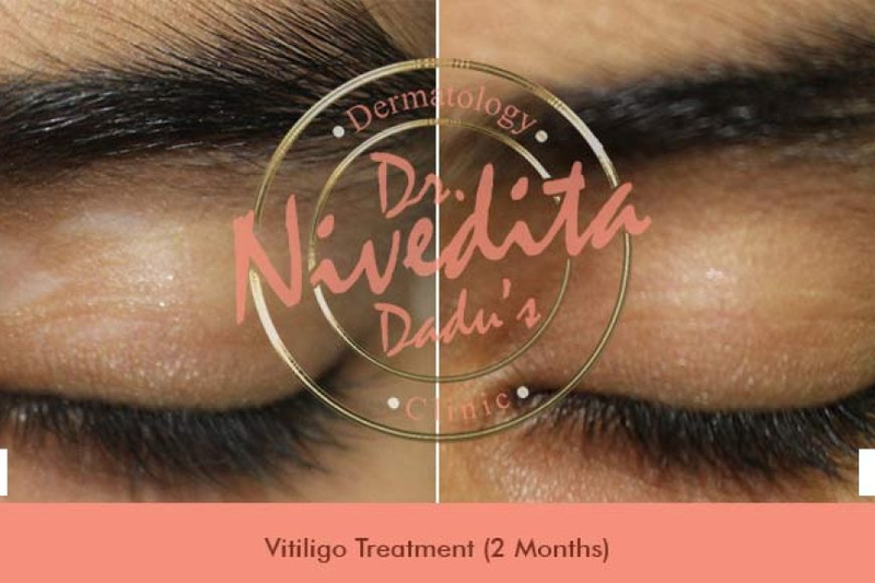 Laser Treatment For Managing Vitiligo: Is It Effective?