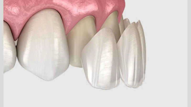 Benefits of Getting Veneers for Front Teeth Gap