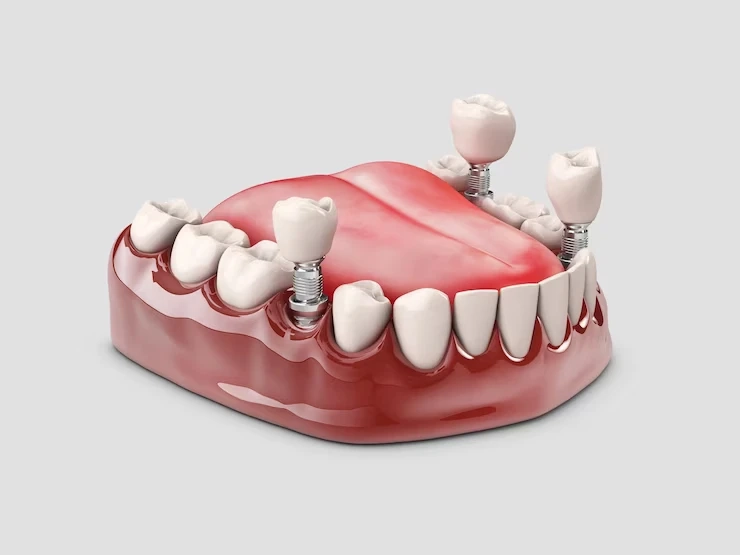 Long- Lasting Solutions for Missing Teeth