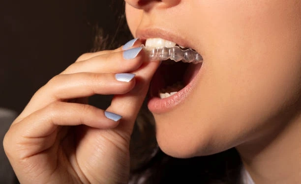 Why More Adults in Glendale CA Are Turning to Clear Aligners