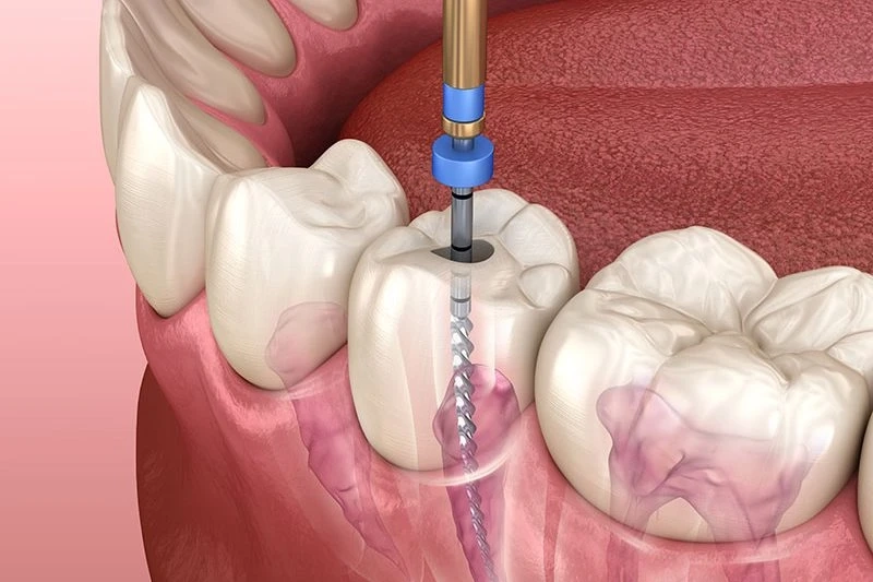 Do you need a crown after Root Canal Treatment?