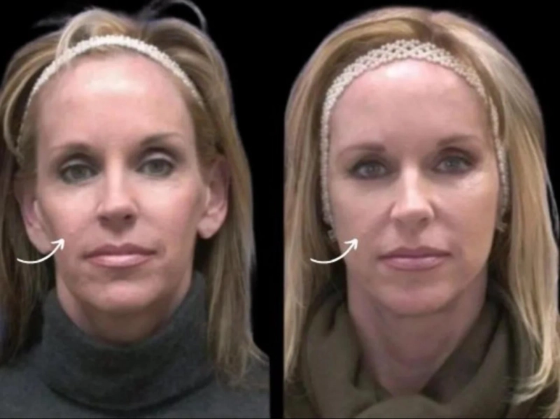 Sculptra Treatment in Dubai Achieve a Hyper Realistic Look