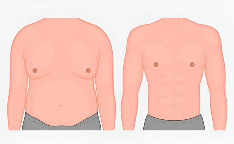 How to Prepare for Your Gynecomastia Surgery?