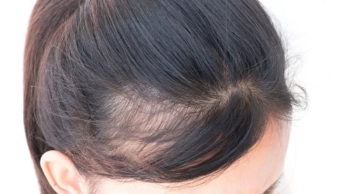 Understanding the Androgenetic Alopecia Treatment Market: Causes, Symptoms, and Treatments