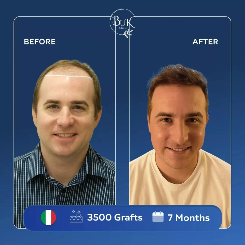 Why Choose Istanbul Over Other Countries for Hair Transplant