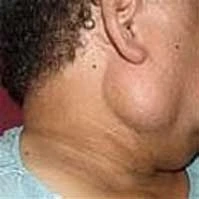 4 Essеntial Tips Bеforе Parotidеctomy - a Bеginnеr's Guidе