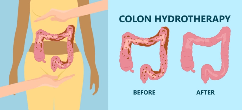 Colonic Hydrotherapist: A Comprehensive Guide For You | Medical Massage Detox