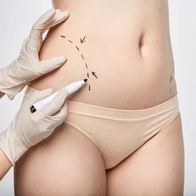 How Do Adipose Lipolysis Injections Compare to CoolSculpting? 