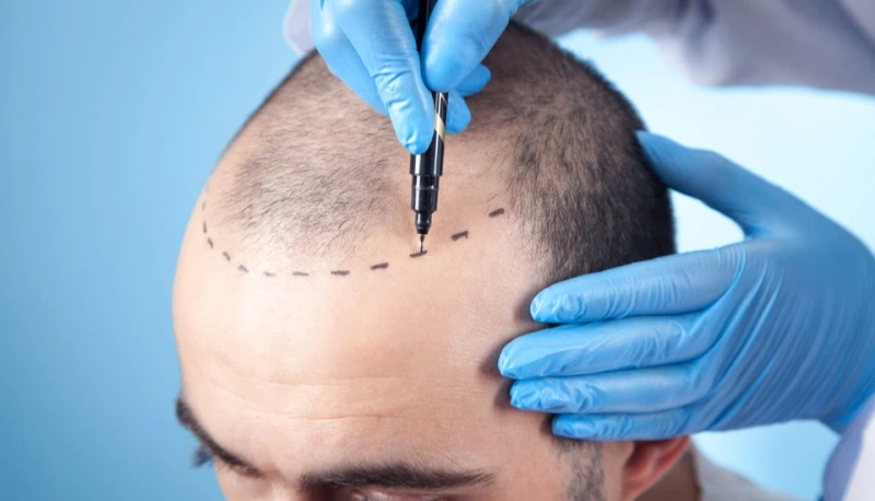 Hair Transplant Antalya