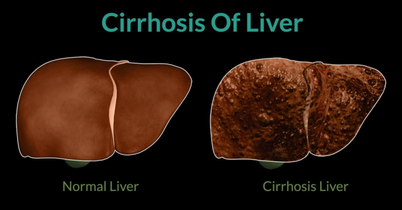 Cirrhosis Disease: Market Insights into Therapeutic Strategies | DLI