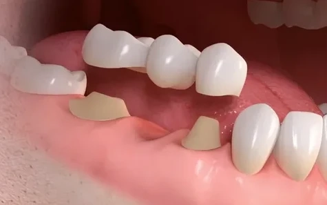 Dental Bridge Peterborough – Restore Your Smile Today