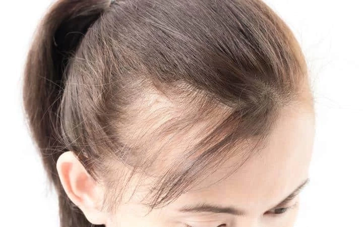 What is The Success Rate of Hair Transplant in Women?