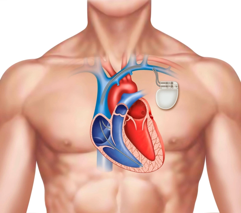 A cardiac pacemaker is a small device inserted into the chest to control the irregular pulse.