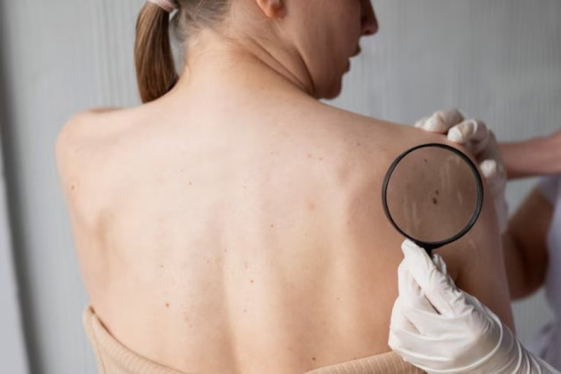 Skin Tag Removal: What You Need to Know Before Getting Started