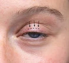 The Complete Guide to Plastic Surgery and Breast Implants in Cape Town