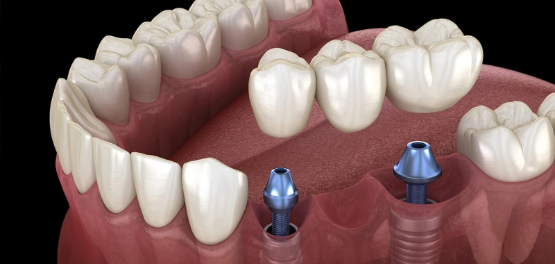 Discover Excellence in Dental Care at the Dental Implant Clinic in South Delhi