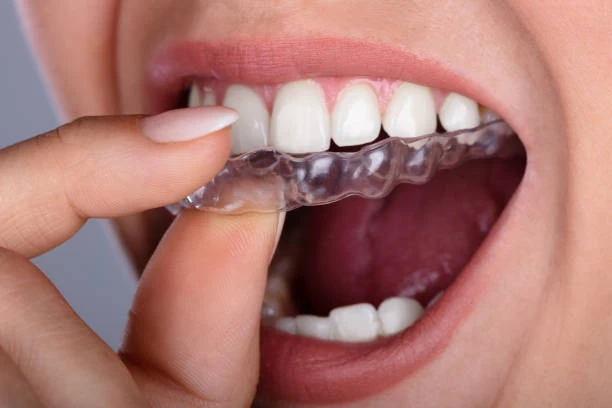 The Clear Choice: Why Invisalign Beats Traditional Braces