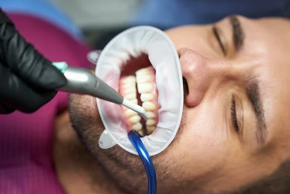 Full Mouth Restoration: Rebuild Your Smile With Our Programs