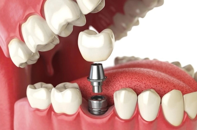 Should I replace my missing tooth with an implant?