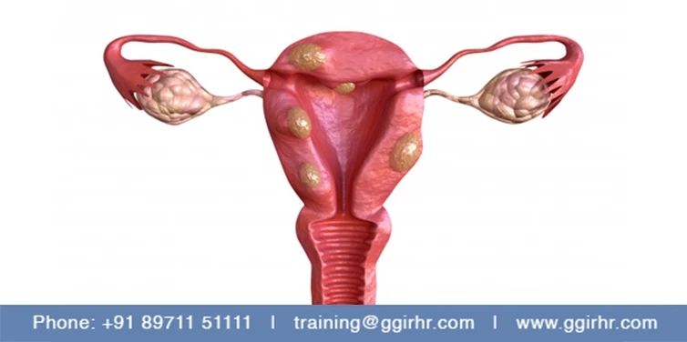 ENDOMETRIOSIS