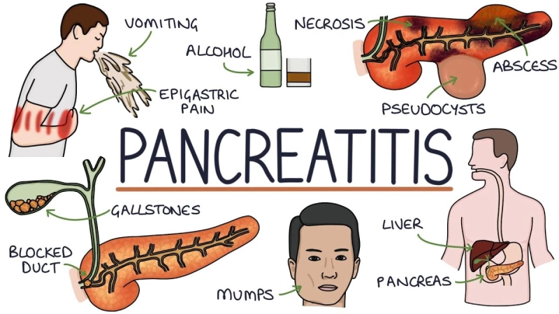 Pancreatitis Explained: When to Seek Help from a Pancreas Doctor