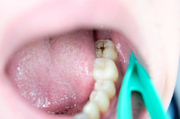 Restore Damaged Teeth and Prevent Decay Dental Fillings in Islamabad: